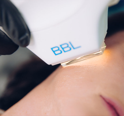 <p>Transform your skin this season with the power duo of <strong>BBL™ + Moxi®</strong>. BBL (BroadBand Light) targets sun damage, redness, and pigmentation, while Moxi® delivers gentle resurfacing to improve texture, tone, and radiance.</p><p>For September only, when you purchase <strong>3 BBL sessions</strong>, you’ll receive a <strong>complimentary Moxi treatment</strong> — the perfect combo for clearer, smoother, and more youthful-looking skin.</p><p>✔ Corrects sun damage, brown spots &amp; redness<br>✔ Smooths rough texture and brightens dull tone<br>✔ Stimulates collagen for lasting rejuvenation<br>✔ Safe, effective, and no major downtime</p>